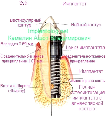 сравнение настоящего зуба с имплантантом